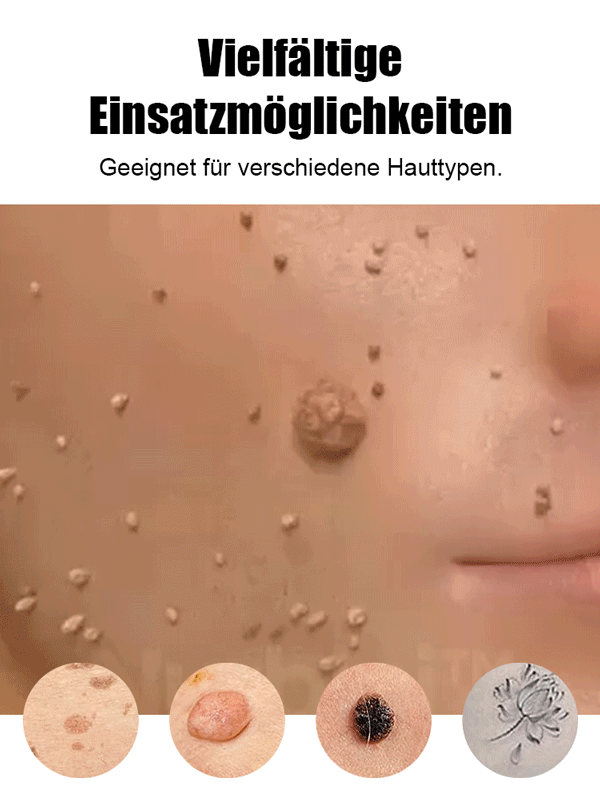 Laser schmerzfreier Warzenentferner-Stift