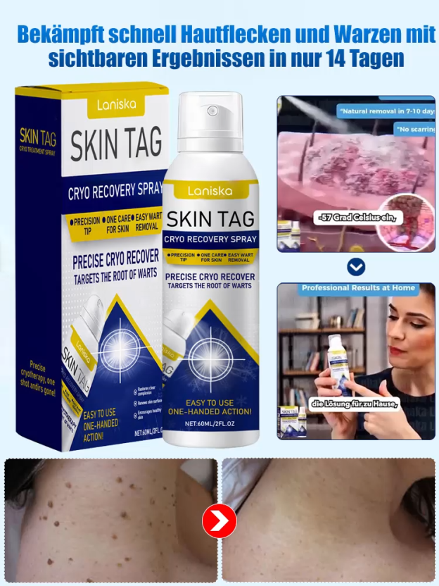 LANISKA Warzenpflege-Spray zur äußerlichen Anwendung【Kaufen Sie 1, erhalten Sie 1 gratis】
