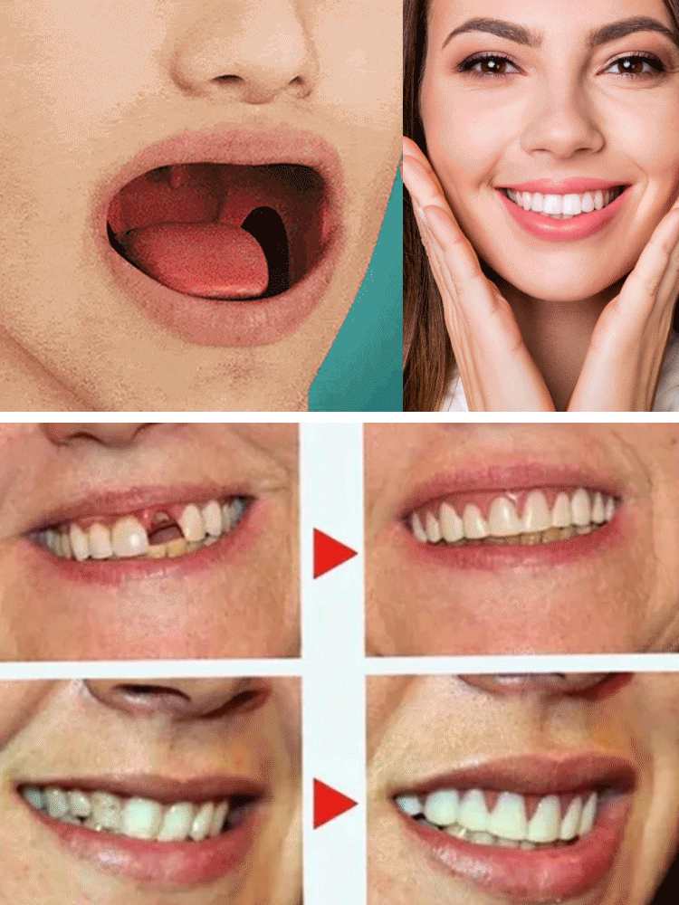[German Patented Technology] 🦷As Secure as Real Teeth, Perfectly Fits the Oral Cavity🕙 Free Trial⚡
