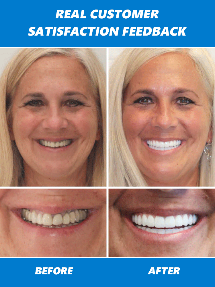 【FDA & BDA Dual Certified】✅ DIY Custom-Fit Denture Kit 🔥【Used by 300,000+ people globally】