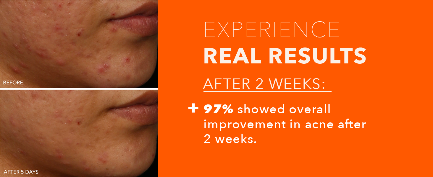 DR DENNIS GROSS DRx SpectraLite FaceWare Pro RESULTS