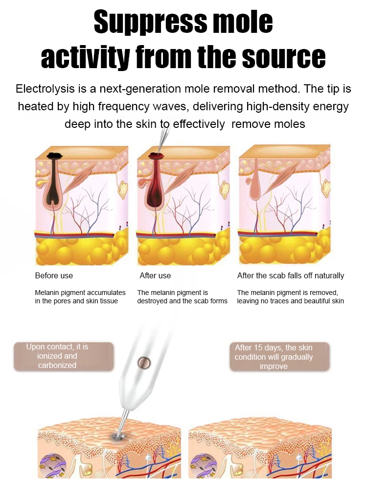 Laser painless wart removal pen✨Say goodbye to moles and warts—without pain, scars, or expensive clinic visits! 