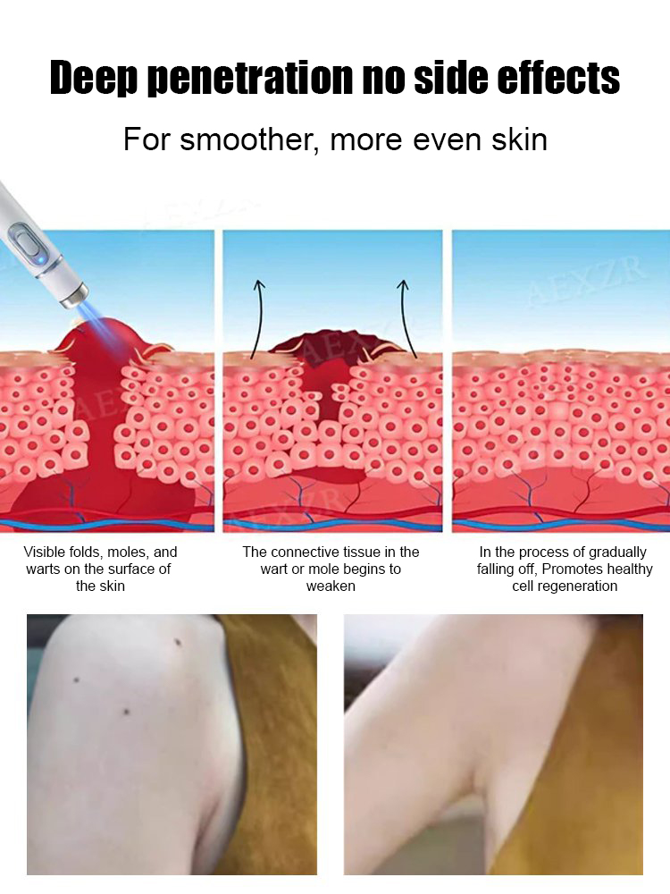 Laser painless wart removal pen✨Say goodbye to moles and warts—without pain, scars, or expensive clinic visits! 