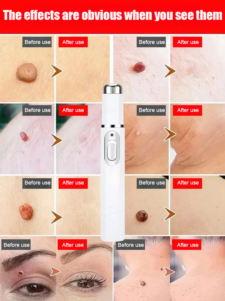 Laser painless wart removal pen✨Say goodbye to moles and warts—without pain, scars, or expensive clinic visits! 