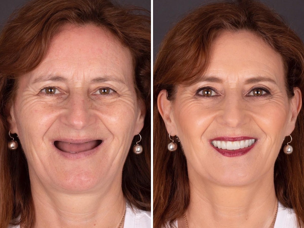 Kit per protesi dentarie in silicone multifunzionale SmileFitPro&trade;