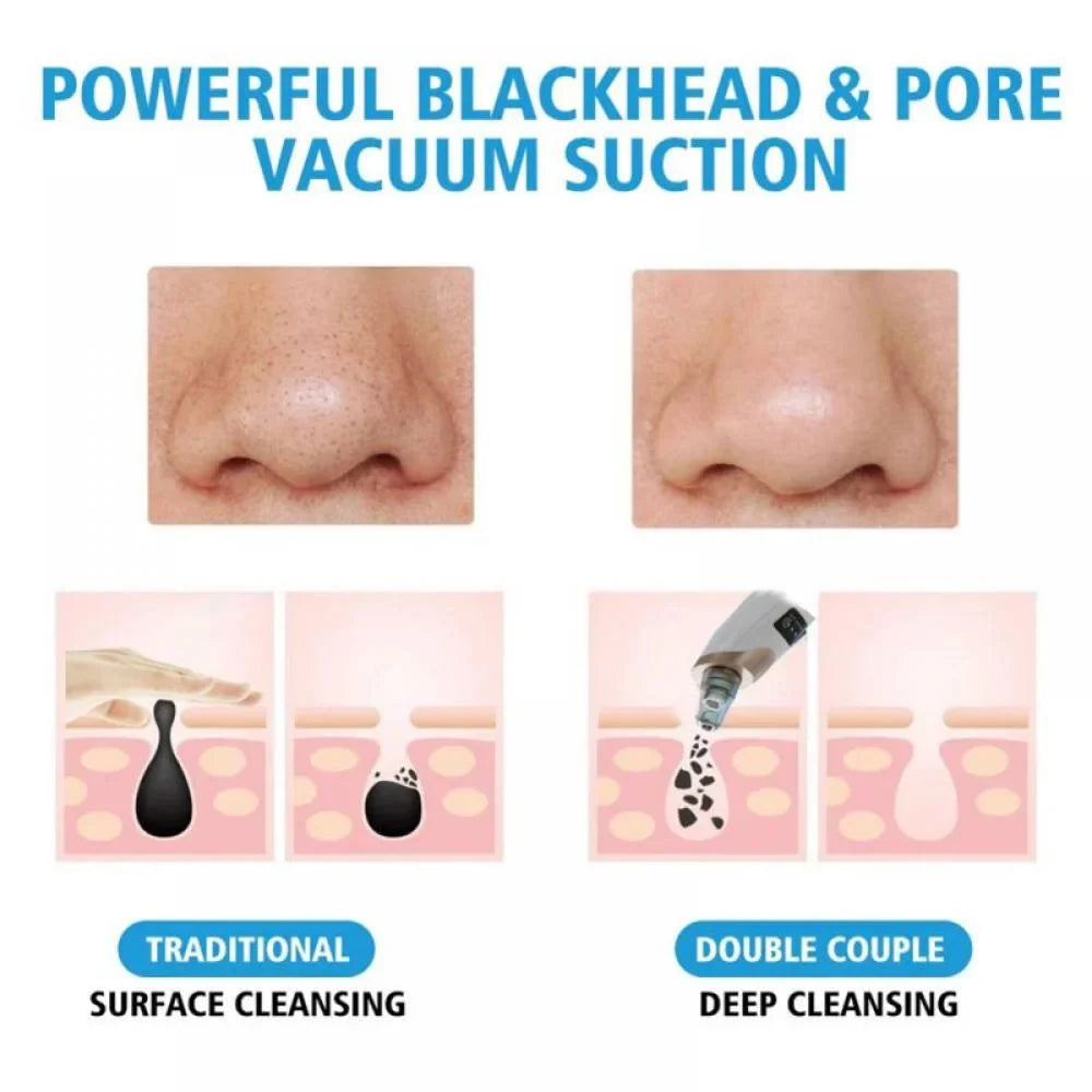 🔥⏰Limited Time Offer 49% OFF🔥-Electric Blackhead Remover