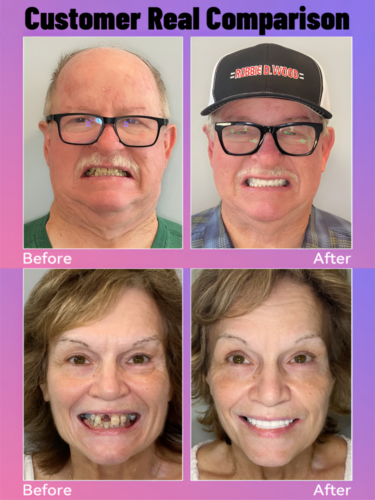 [Brighten Your Smile] High-End Custom-Made Dentures-Wear for life, no replacement needed!