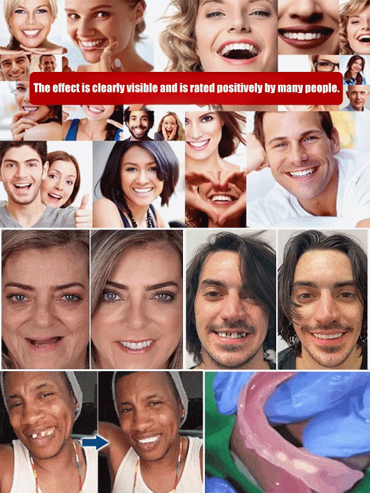 Comfortable denture set that supports facial structure-Wear for life, no replacement needed!