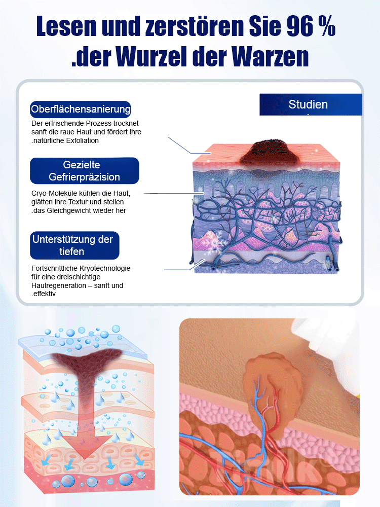 Warzen Entfernungs Spray – Schmerzfrei & Schnell