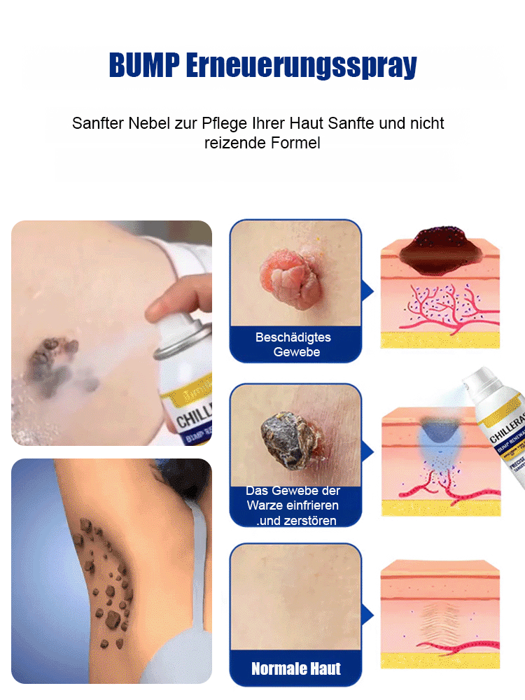 Warzen Entfernungs Spray – Schmerzfrei & Schnell