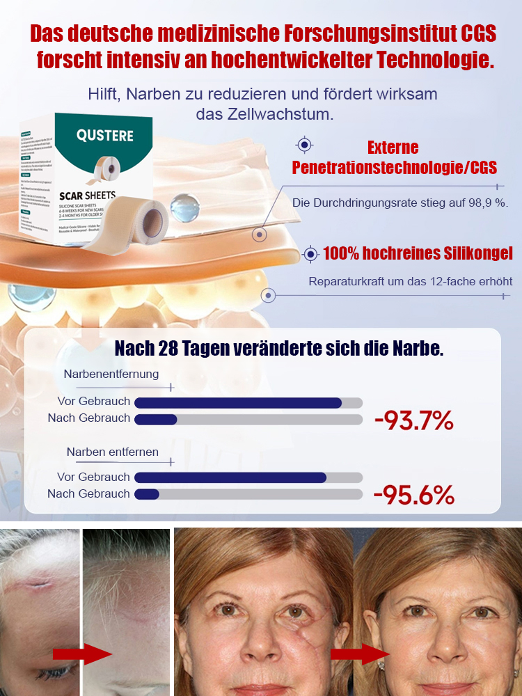 24-Stunden-Silikon-Gel-Narbenpflaster zur kontinuierlichen Narbenpflege