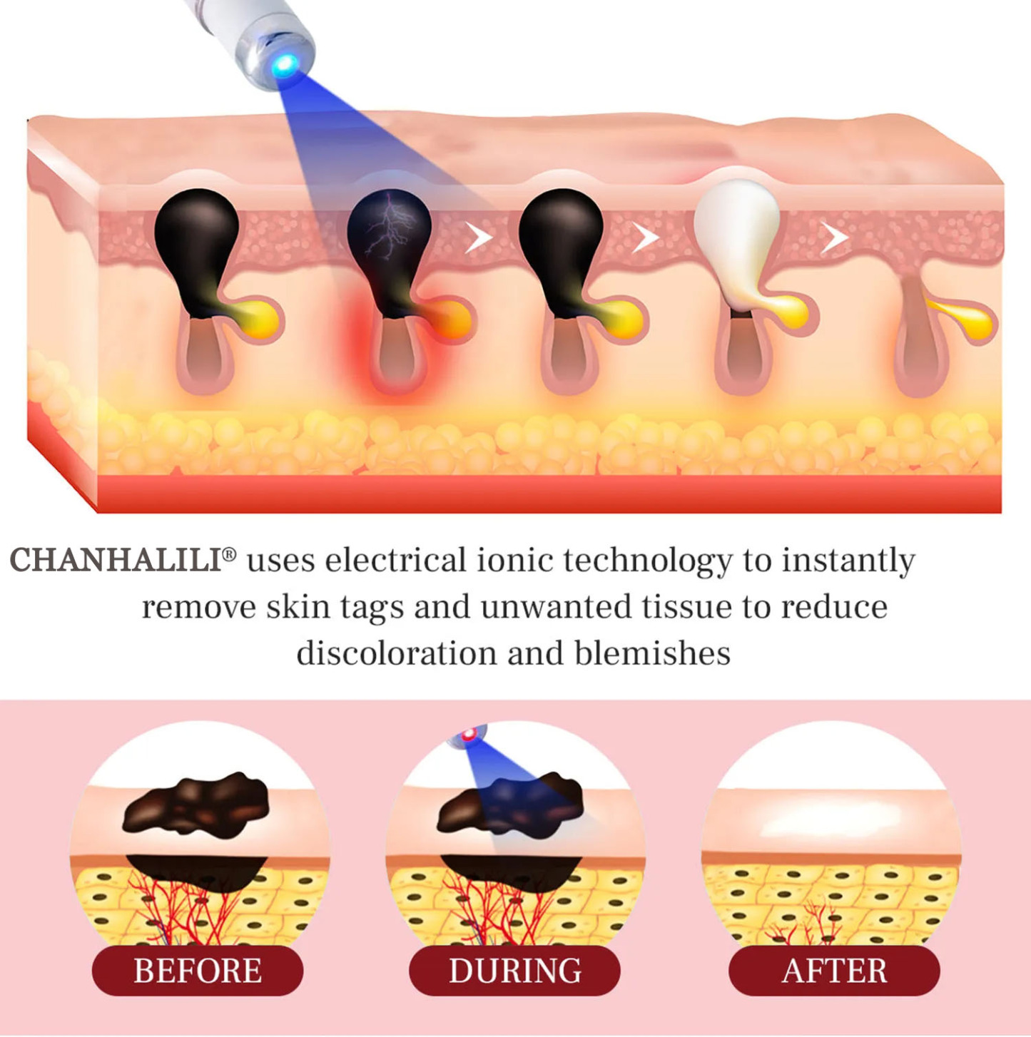 ❤CHENHALILI® LumeSkin Mole and Wart Removal Laser Pen ❤️