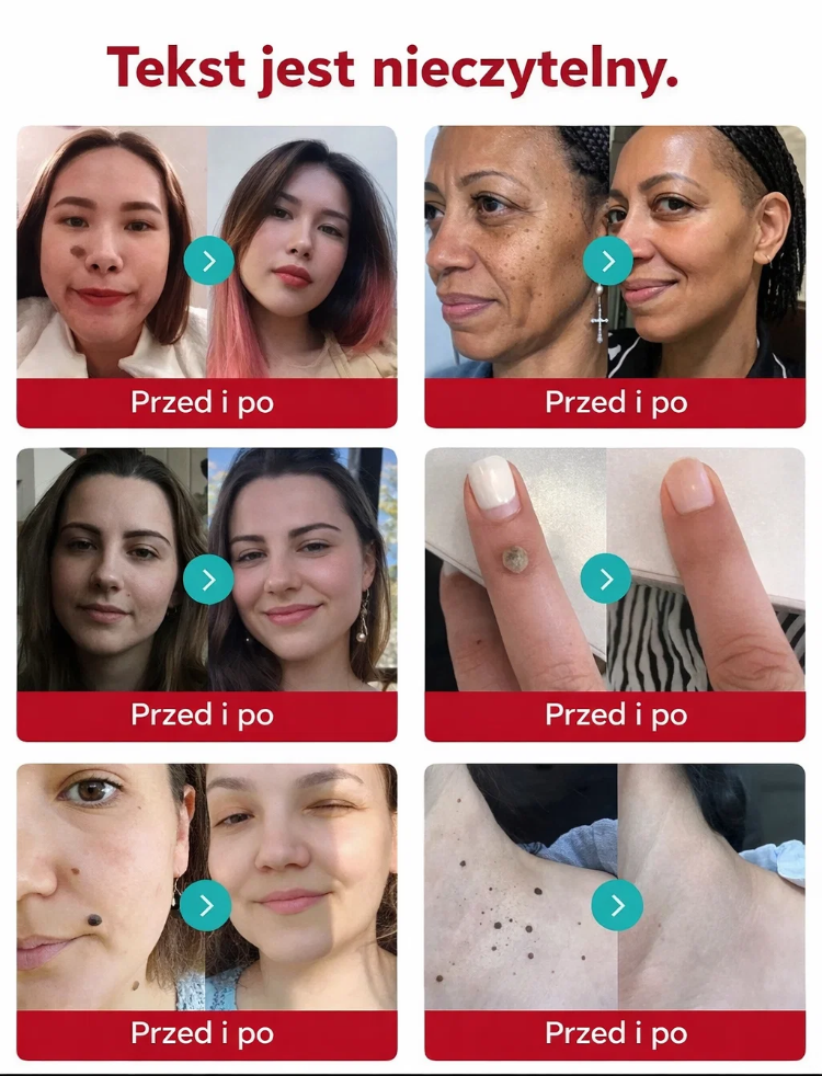 🧪 Zatwierdzona przez FDA Medyczna Maść na Brodawki Xirmonth™ – Niemiecka Formuła SGS, 10x Silniejsze Działanie Przeciwwirusowe HPV, Dziś 50% Taniej + 30 Dni Gwarancji Zwrotu Kosztów