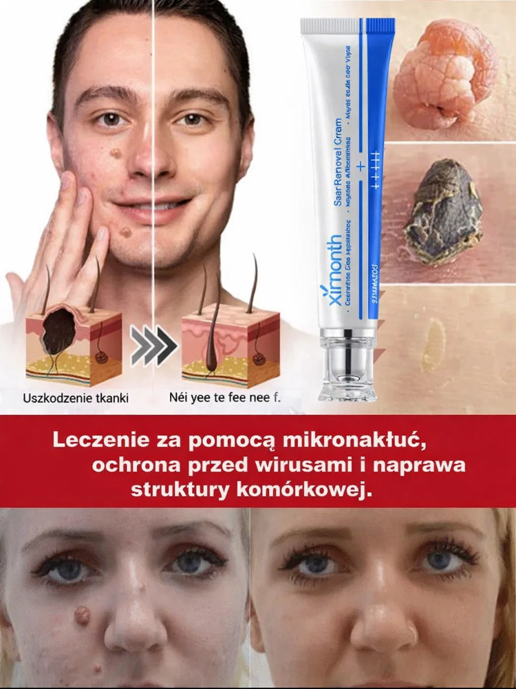 🧪 Zatwierdzona przez FDA Medyczna Maść na Brodawki Xirmonth™ – Niemiecka Formuła SGS, 10x Silniejsze Działanie Przeciwwirusowe HPV, Dziś 50% Taniej + 30 Dni Gwarancji Zwrotu Kosztów