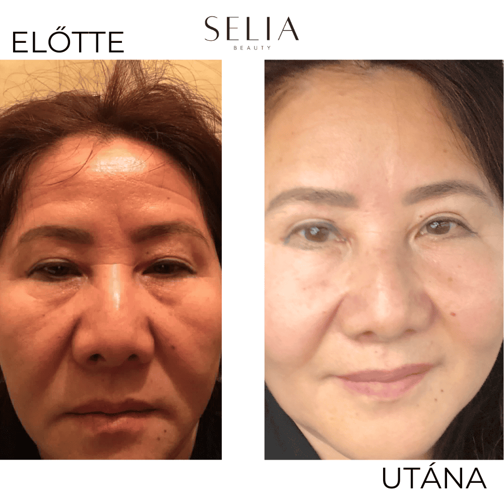 Selia aranytűs mikroinfúziós kezelés