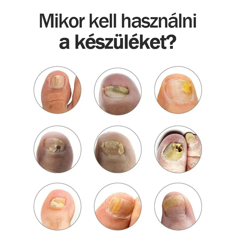 Orthovita gombás fertőzés kezelő eszköz