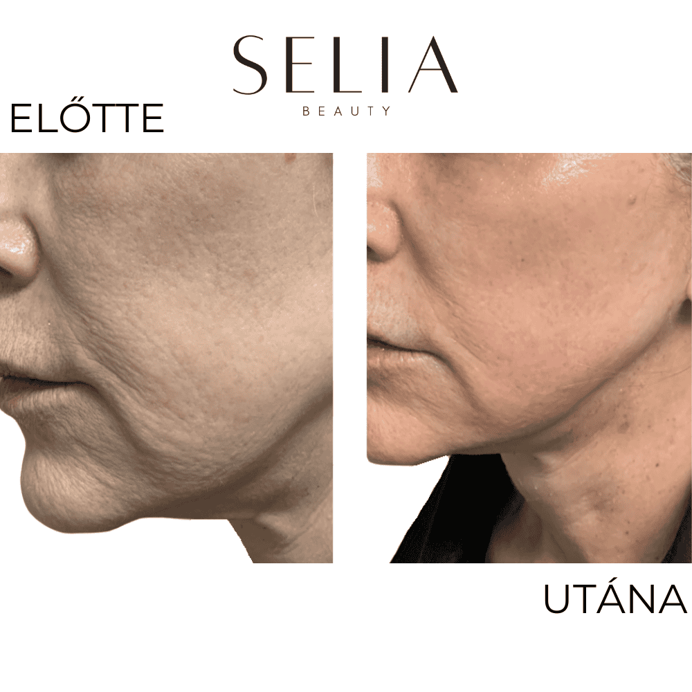 Selia aranytűs mikroinfúziós kezelés