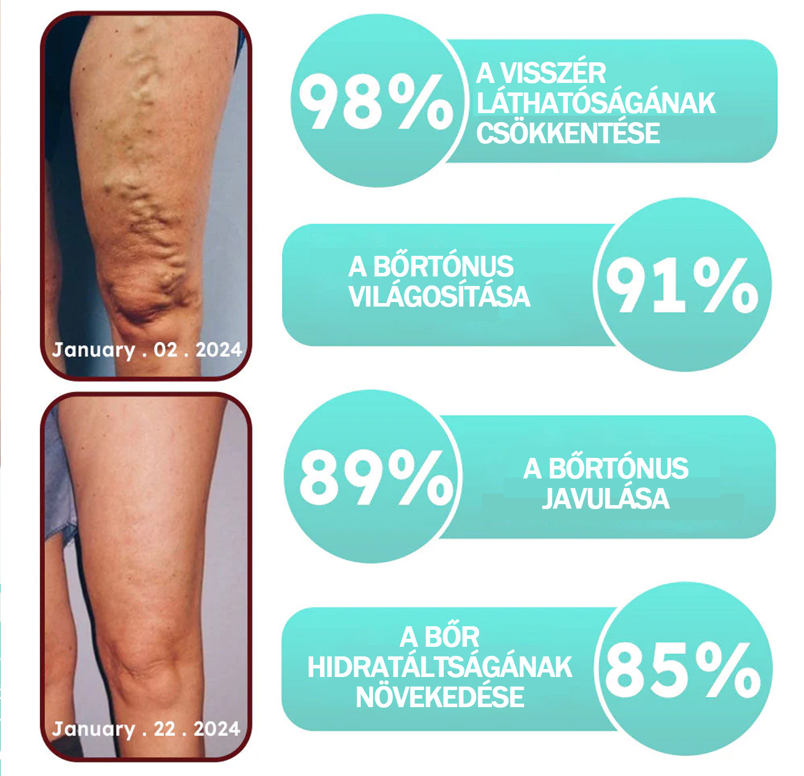 ✨ Lovilds™ Pióca Visszér Tapasz - 85% kedvezmény! 🌸Klinikailag bizonyítottan gyorsan csökkenti a visszér méretét!