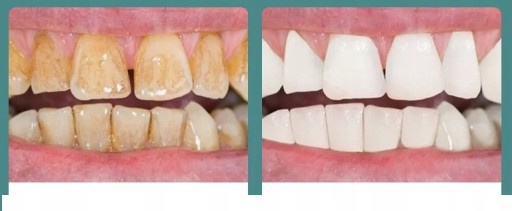 ULTRAHANGOS FOGÁSZATI MÉRLEG ERŐS VÍZKŐ ELTÁVOLÍTÁS