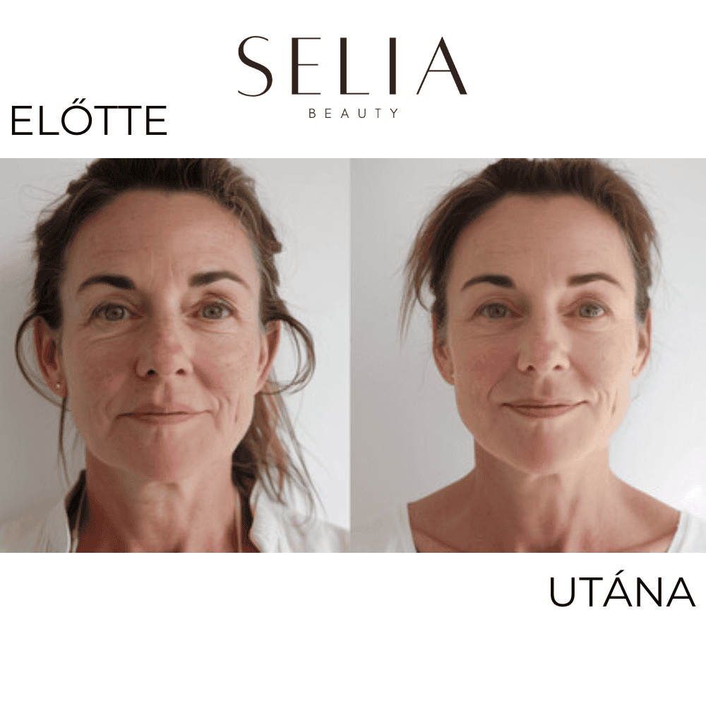 Selia aranytűs mikroinfúziós kezelés