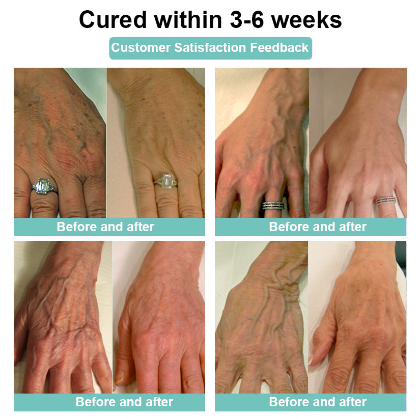 ✨ Lovilds™ Leech Varicose Vein Patch - 85% off! 🌸Clinically proven to quickly reduce varicose veins!