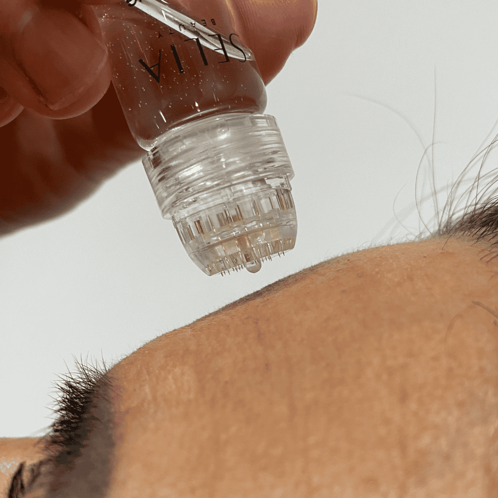 Selia aranytűs mikroinfúziós kezelés