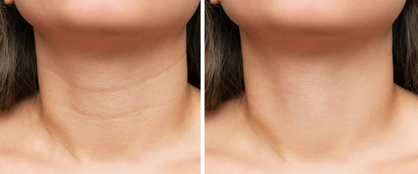 Zpevňující liftingový krém odstraňuje vrásky za 60 sekund