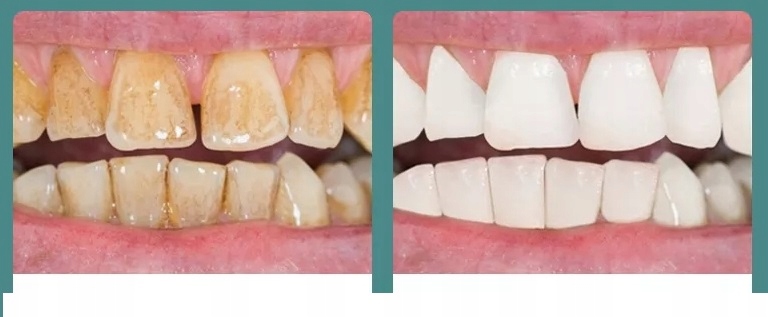 ULTRAHANGOS FOG&Aacute;SZATI M&Eacute;RLEG ERŐS V&Iacute;ZKŐ ELT&Aacute;VOL&Iacute;T&Aacute;S Alapsz&iacute;n feh&eacute;r