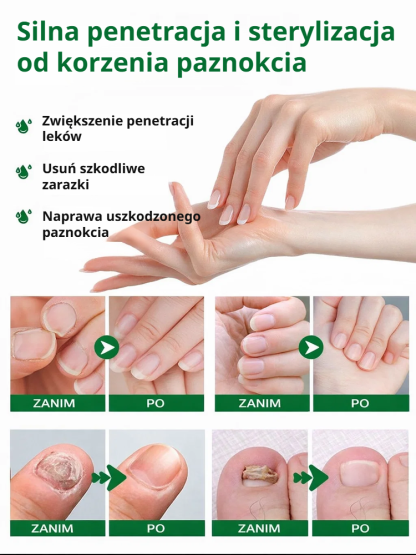 💅Roztwór do leczenia grzybicy paznokci｜🌿Drzewo herbaciane + imbir głęboko regeneruje łożysko paznokcia, odpowiedni do dłoni i stóp
