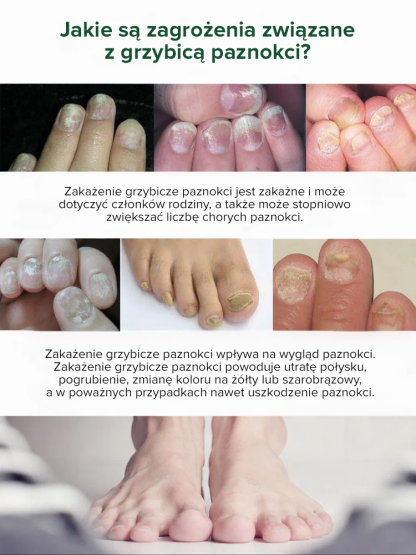 💅Roztwór do leczenia grzybicy paznokci｜🌿Drzewo herbaciane + imbir głęboko regeneruje łożysko paznokcia, odpowiedni do dłoni i stóp