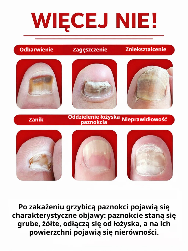 💅Roztwór do leczenia grzybicy paznokci｜🌿Drzewo herbaciane + imbir głęboko regeneruje łożysko paznokcia, odpowiedni do dłoni i stóp