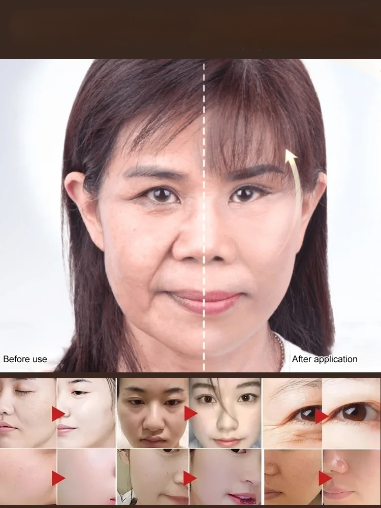 ✨ Peptide fillers instantly smooth fine lines. 💎 Plump and firm, restoring a youthful appearance.