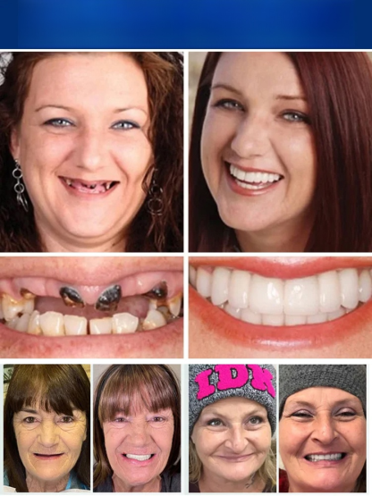 🦷Developed by 100 dentists, say goodbye to high prices! Made of soft silicone, they're as comfortable as real teeth!