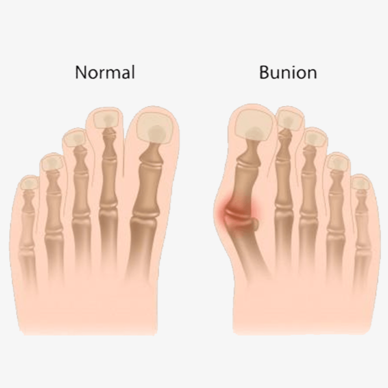 2 Pack: Comfort Healing Toe Separators and Bunion Spacers - FREE SHIP DEALS
