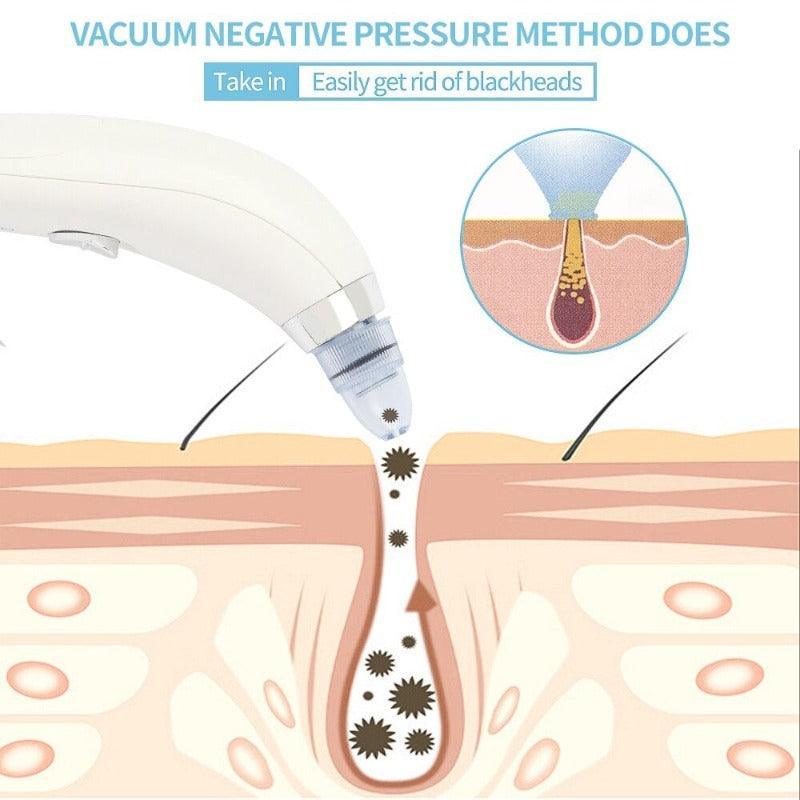 Blackhead Removal Face Massager – Deep Cleaning And Exfoliation-My Makeup Brushset