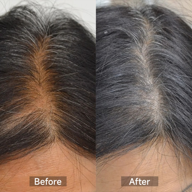 VeonSkin GrowMax – Berretto Laser e LED per la ricrescita dei capelli