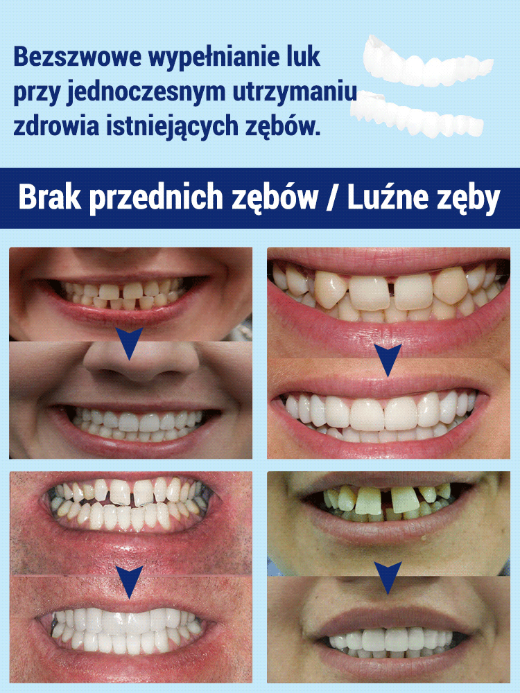 Zestaw do poprawy uśmiechu z protezami kosmetycznymi Poprawa estetyki uśmiechu Komfortowy materiał