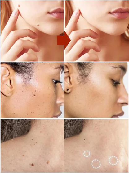 Laserowe bezbolesne pióro do usuwania brodawek