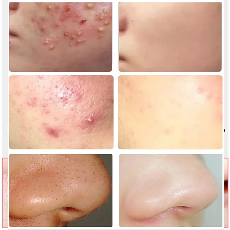 Estetyka bez skazy ✨ Precyzyjne i wytrzymałe szczypce komórkowe 💎🧖‍♀️ Przywracające czystą teksturę skóry