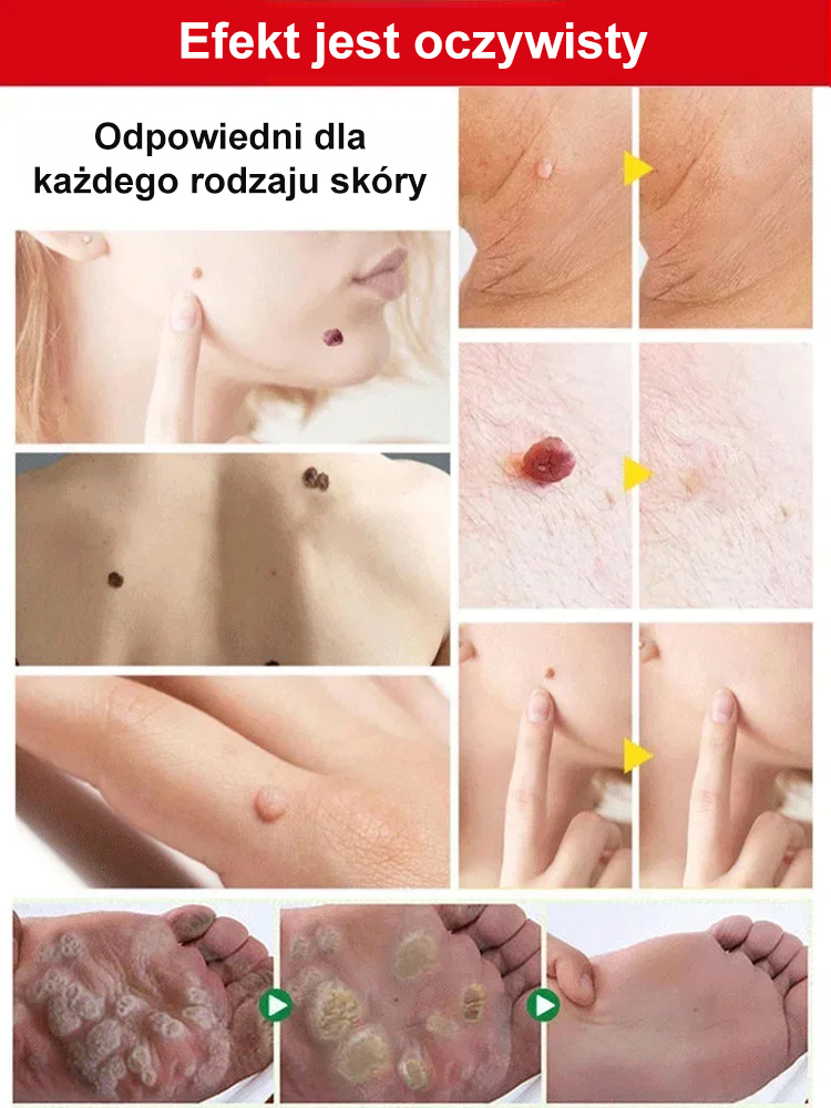 【Usuwanie kurzajek bez nawrotów】Spray do pielęgnacji skóry do użytku zewnętrznego