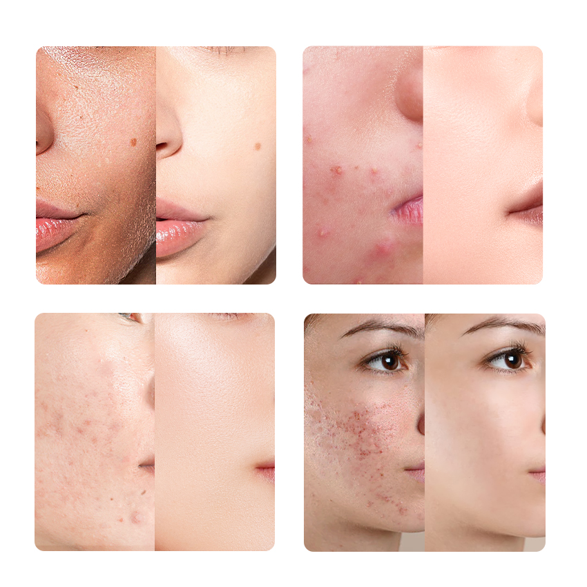 Salicylic Acid Oil & Acne Travel Kit-SKINEVER