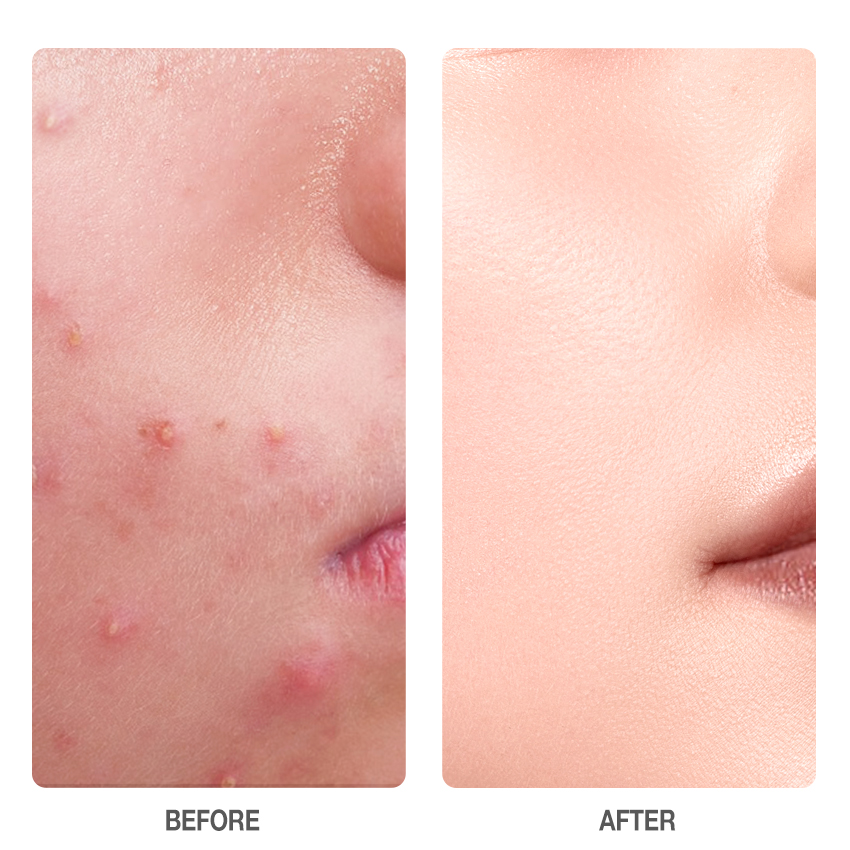 Salicylic Acid Acne Treatment Ice Sleep Masque -SKINEVER