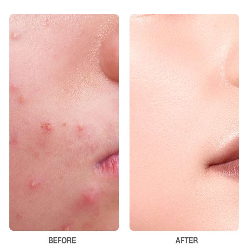 Salicylic Acid Acne Treatment Ice Sleep Masque -SKINEVER