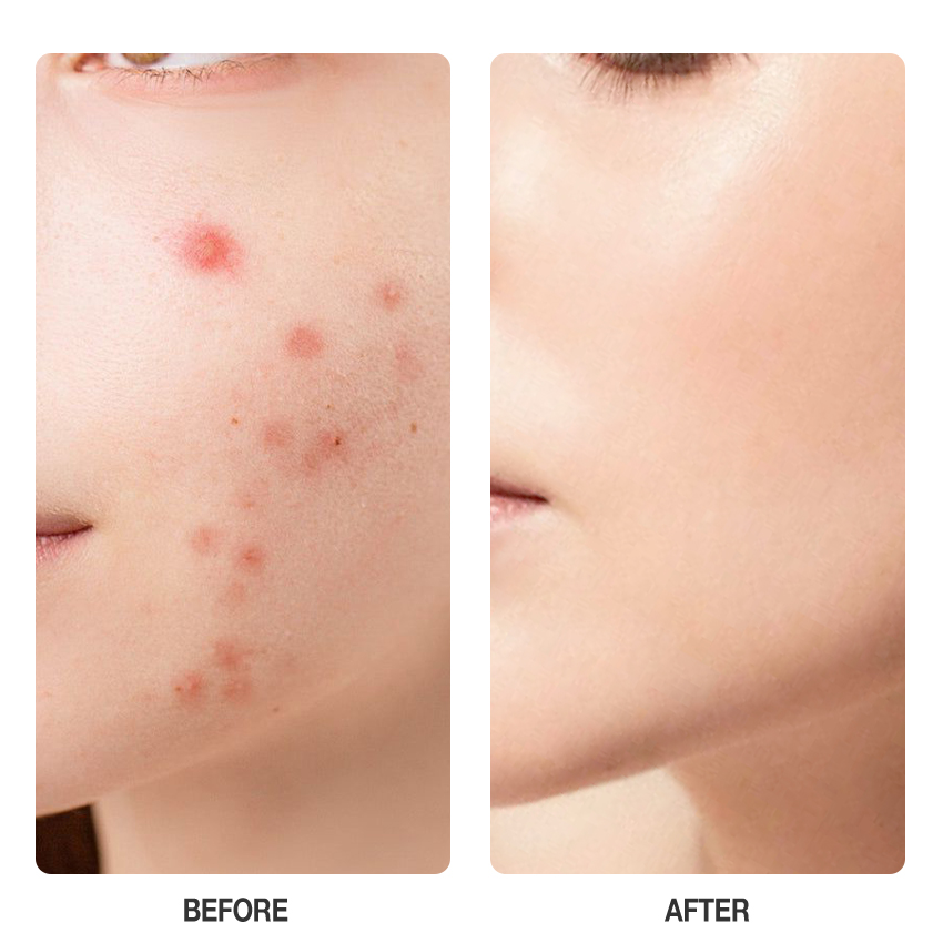 Salicylic Anti Acne Serum-SKINEVER