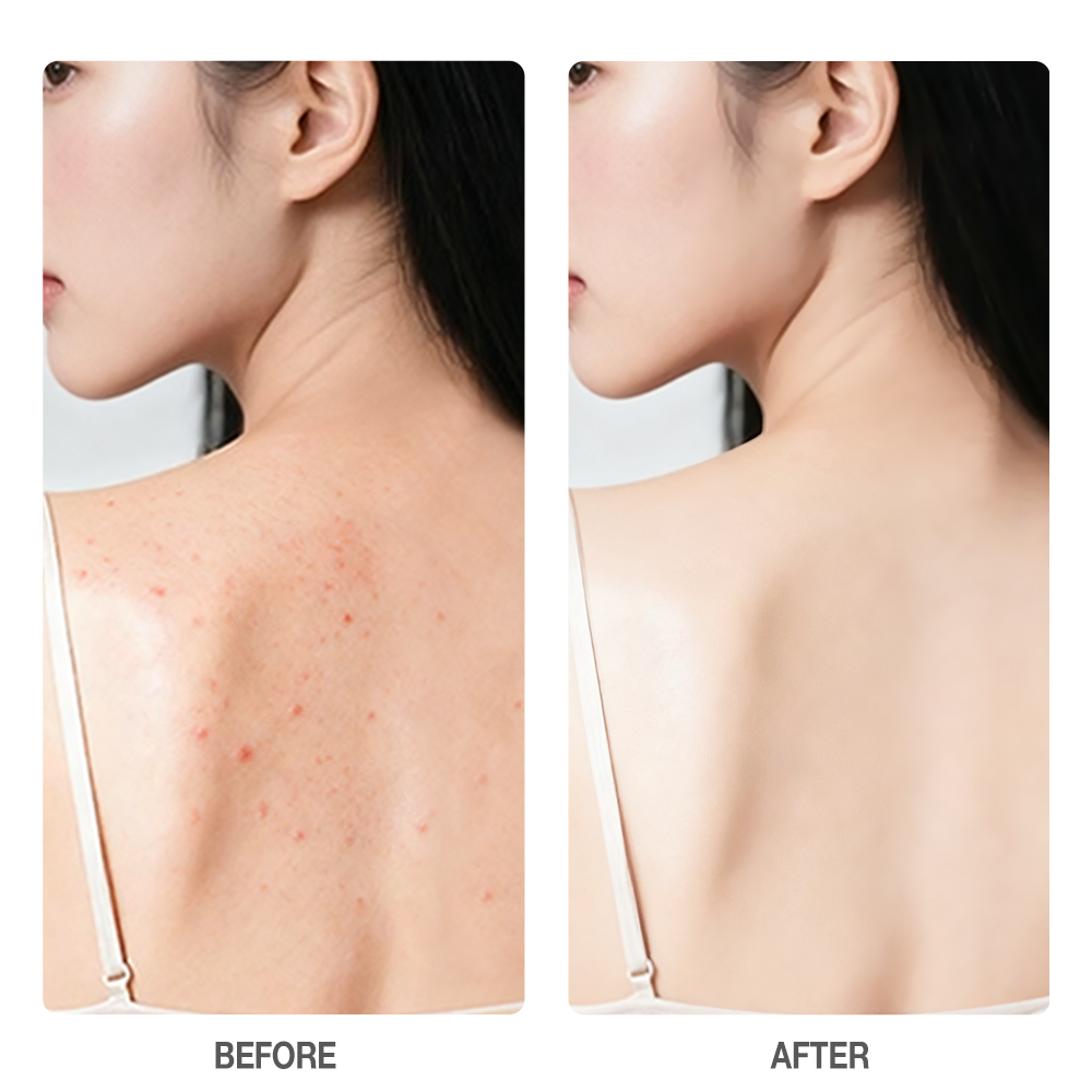 SKINEVER Salicylic Acid Acne Skin Body Wash Deeply Oil Control Sulphur Mite Removal Shower Gel 200ml-SKINEVER