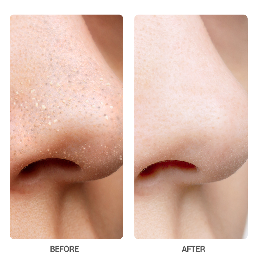 Salicylic Acid Blackhead Purifying & Pore Minimizing Set