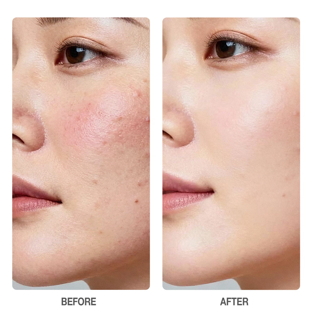 Salicylic Acid Rapid Acne Gel Serum