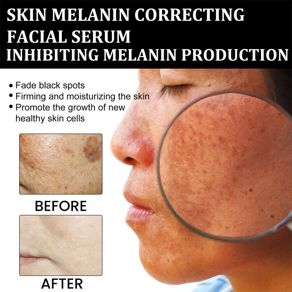 （🔥LAST DAY SALE-80% OFF)Fast Dark Spot Remover-Melanin Correcting Facial Serum