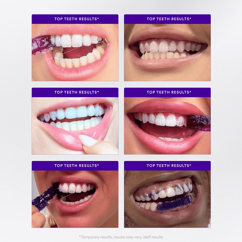 Colour corrected teeth covered in V34 Colour Corrector Serum and home teeth whitened