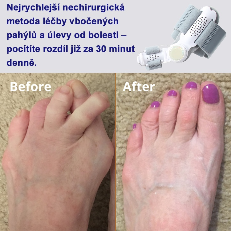 ✨Strážce zdraví palce: korektor valgózní deformace🏆